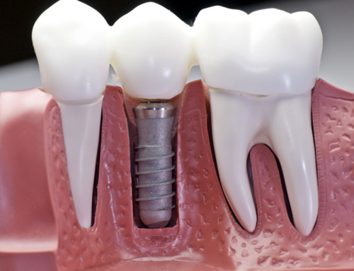 8 Advantages of Dental Implants for Missing Teeth
