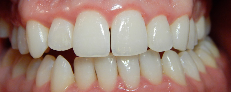 mouth with white teeth