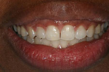 Invisalign After (2)