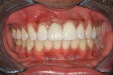 Dental Implant After