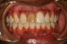 Dental Implant Before 