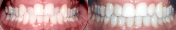 Invisalign results cross-bite 