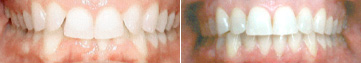 Invisalign results overbite