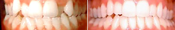 Invisalign results crowding