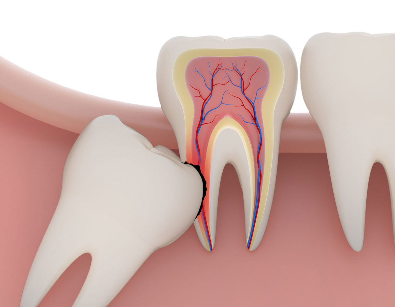 wisdom tooth extraction