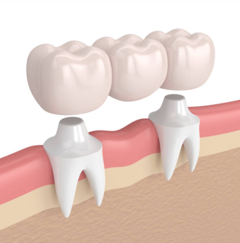 Tooth model showing dental bridges