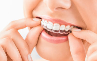Teeth Whitening Strips & Trays