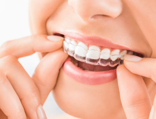 Teeth Whitening Strips & Trays – Which Are Better?