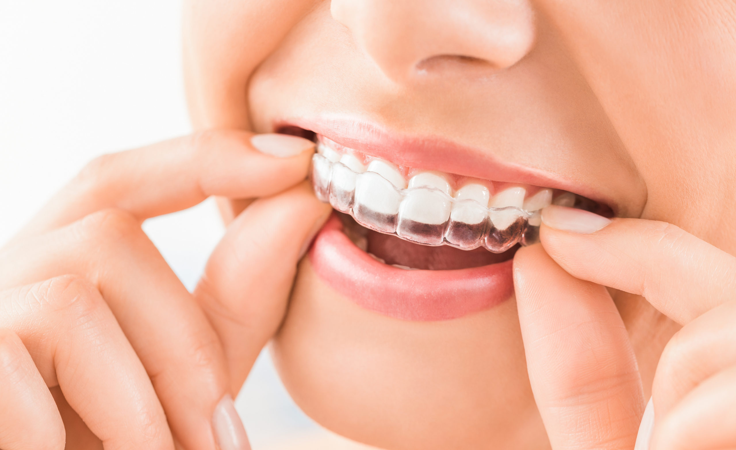 Teeth Whitening Strips & Trays